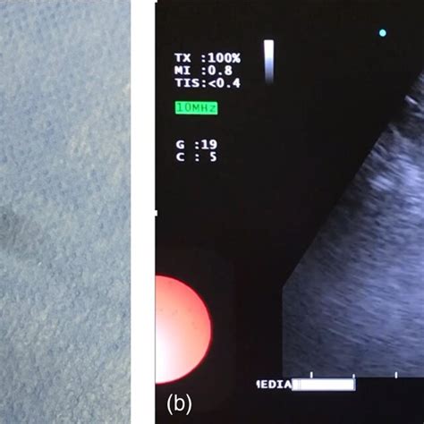 A Endobronchial Ultrasound‐guided Ebus Biopsy Forceps B