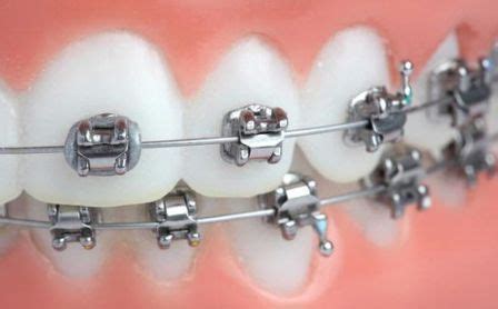 Pendakap gigi jenus clear adalah rm 7,000 hingga rm 9,000. Harga Pasang Behel Gigi di Dokter Gigi :http://hamilplus ...