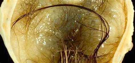 An ovarian cyst is a sac filled with fluid or a semisolid material, that forms on or inside the ovaries. Dermoid cyst Archives - All information about cysts