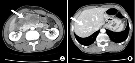 Abdominal Ct Scan A Ct Scan Showed Contrast Enhancement Of The Tumor