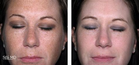 Ipl Photofacial Not Just Hype Spa Md Consultantsspa Md