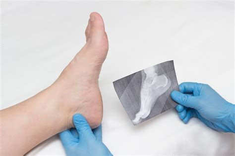 Bone Spur Treatment And Diagnosis Arizona Foot Doctors