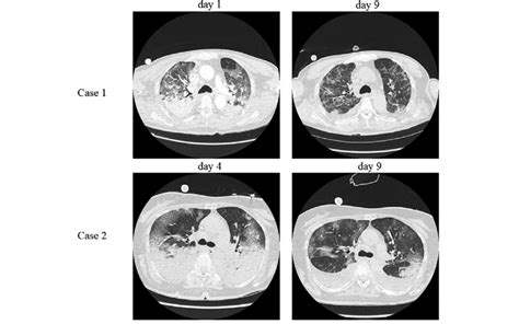Chest Computed Tomography Scans Of Two Patients With Covid 19 Treated