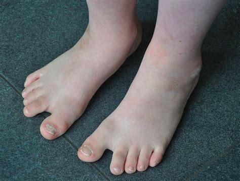 Rocker Bottom Feet Trisomy 18