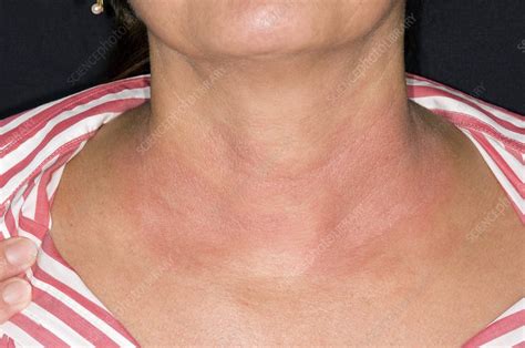 Eczema On The Neck Stock Image C0085600 Science Photo Library