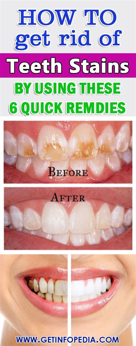 Wolff, dds, phd, professor at the new. Home Remedies to Get Rid of Teeth Stains | Stained teeth ...