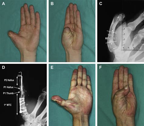 Primary Thumb Reconstruction In A Mutilated Hand Hand Clinics