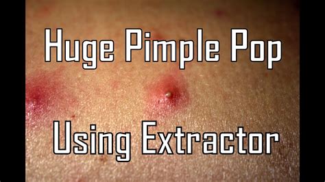 Huge Pimple Pop Using Extractor Back Zit Youtube