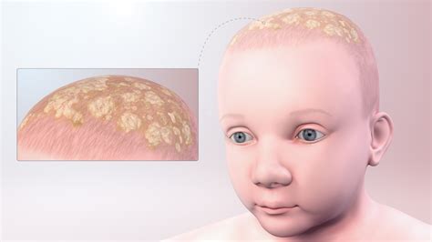 Cradle Cap Symptoms Causes And Treatment Scientific Animations