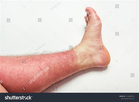 Dangerous Suntan Sun Sunburn On Skin Stock Photo 1140689765 Shutterstock