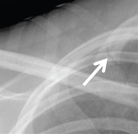 Non Traumatic First Rib Fracture In University Wrestler