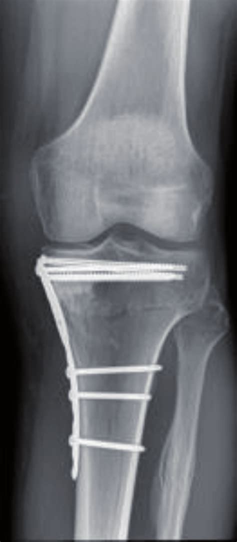 Ap Radiograph Of A Medial Tibial Plateau Fracture Treated By Orif With