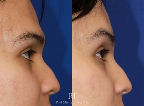 Type 3 Brow Bone Reduction And Brow Lift Before And After Photos
