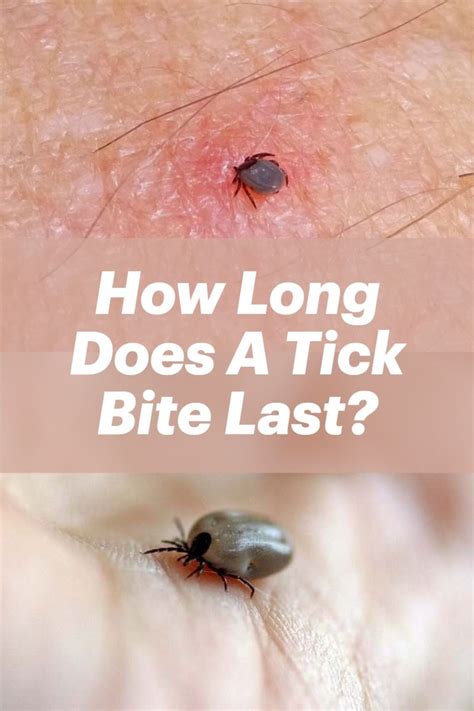 How Long Does It Take For Tick Bites To Go Away Howtoermov