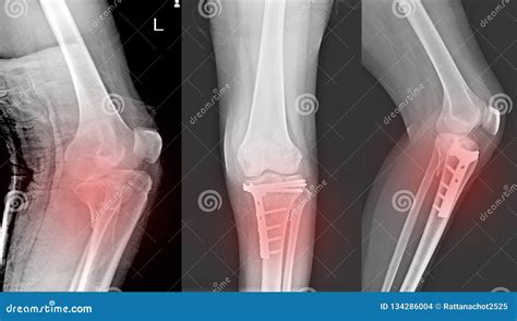 X Ray Knee Fracture Proximal Metaphysis Of Tibiadepressed Fracture Of