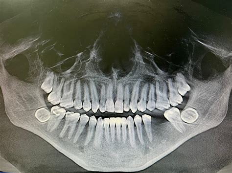 CBCT Panoramic View Showed A Bilateral Impacted Mandibular Third Molars