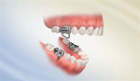 En mara dental, queremos que te sientas como en tu casa, por eso somos una clínica dental cercana y familiar; Mandibular Anterior Repositioning Appliance (MARA) | ارتوسرجری