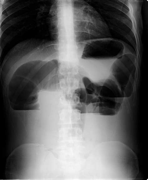 Small Bowel Obstruction Radiology Case Radiología