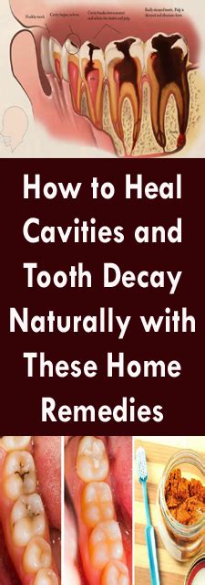 How To Heal Cavities And Tooth Decay Naturally With These Home Remedies