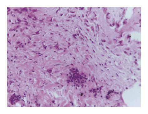 Histological Study A Periosteal Reaction With Inflammatory Grouped