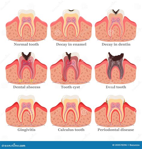 Tooth Disorders Set Flat Vector Illustration Healthy And Unhealthy