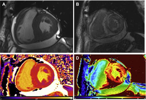 The Role Of Cardiac Mr Imaging In The Assessment Of Patients With