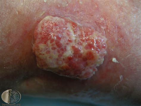 Squamous Cell Cancer Photo Gallery Dr Dilshaad Asmal Dermatologist