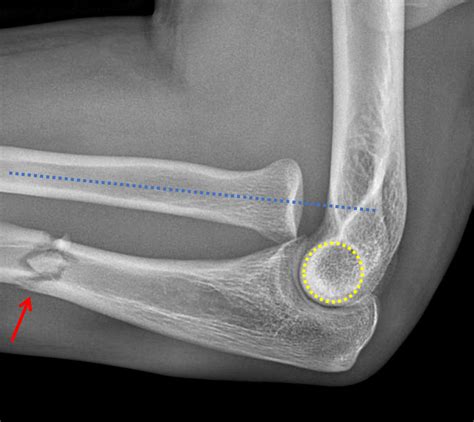 Monteggia Fracture Ulnar Fracture Radial Head Dislocation