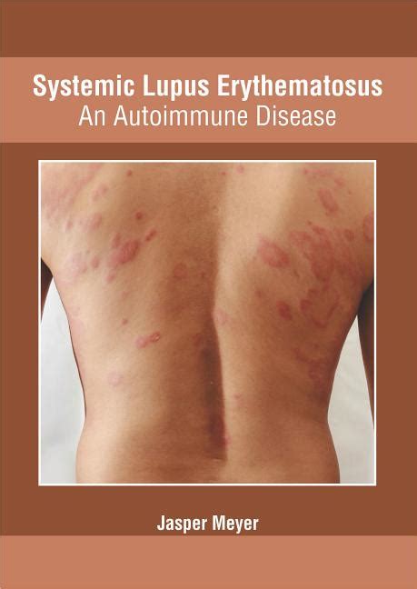 Systemic Lupus Erythematosus An Autoimmune Disease Hardcover