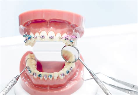 Full Mouth Restoration Markic Dental