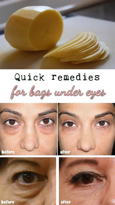Quick Remedies For Bags Under Eyes Puffy Eyes Remedy Health And
