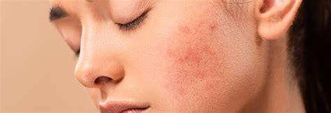 Rosacea Vs Acne How To Spot The Difference Strut Blog
