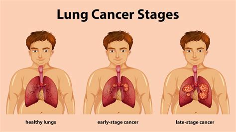 A Complete Guide To Learn Everything About Lung Cancer Yashoda Hospital