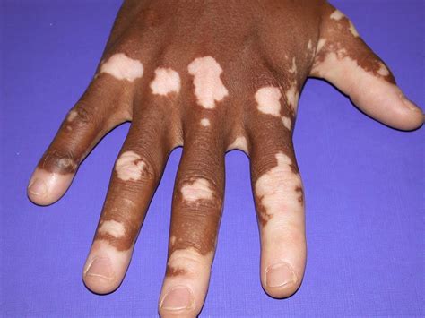Different Types Of Human Skin Diseases And Their Differentiation