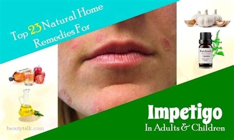 Looking For Natural Home Remedies For Impetigo That Work Here Are Top
