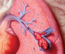 Evaluation of an incidental solitary pulmonary nodule. Pulmonary Embolism Symptoms, Causes and Treatment | Health ...