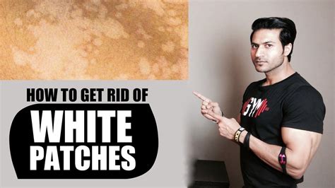 He thought it would be. How to Get Rid of WHITE PATCHES (सफेद दाग) on Skin ...