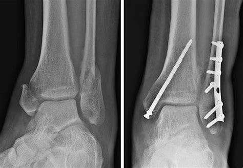 What Is Ankle Fracture Surgery Orthopedic Specialists Of Seattle