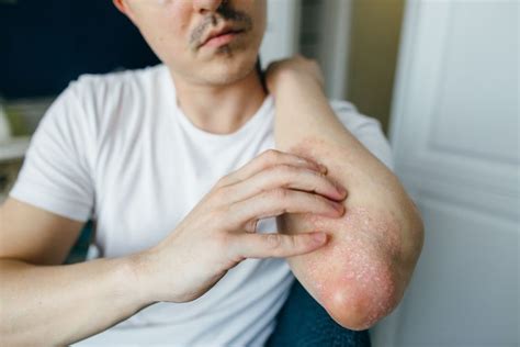 Eczema Facts And Statistics What You Need To Know