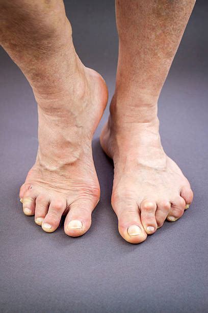 410 Rheumatoid Arthritis Feet Stock Photos Pictures And Royalty Free