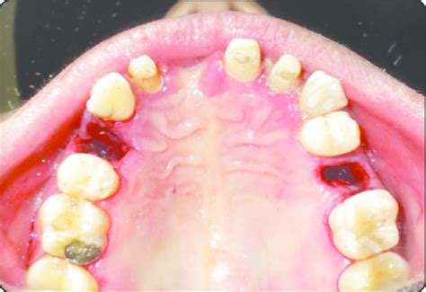 Intraoral Photograph Showing Empty Sockets After Extraction Download