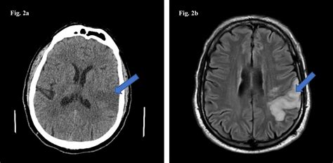 Cureus Acute Ischemic And Hemorrhagic Stroke In Covid 19 Mounting