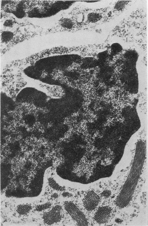 Electron Micrograph Ofinterstitial Lymphocyte Containing Cytoplasmic