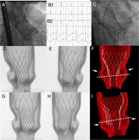 Supra Annular Position Of A Transcatheter Aortic Valve Prosthesis From