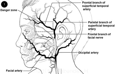 Temporal Artery Biopsy Anatomy