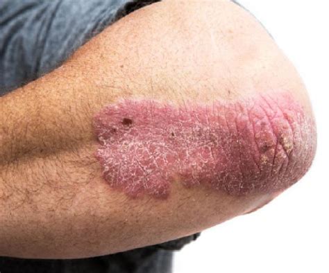 What Does A Psoriasis Rash Look Like United States