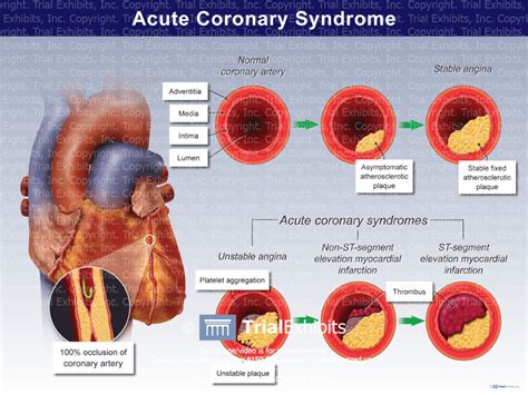 Acute Coronary Syndrome Trial Exhibits Inc