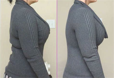 Real Life Transformations In Our No Back Fat Bra Before And After