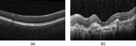 Oct Images Of Retina A The One With Clear Rpe Layer And B The One