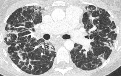 Upper Zone Axial Ct Chest Image In A Patient With Cvid Which Shows